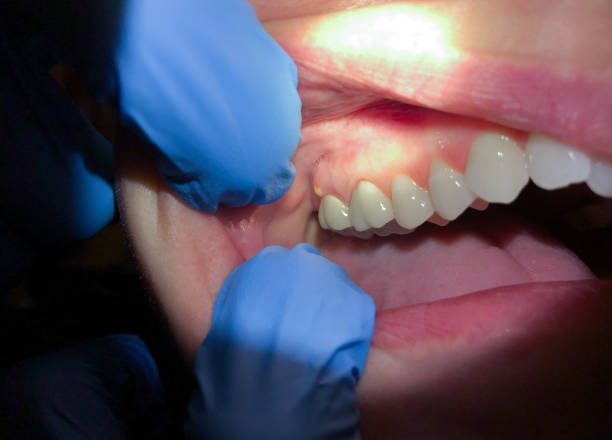 Best Emergency Gum Treatment in Granvle, IL